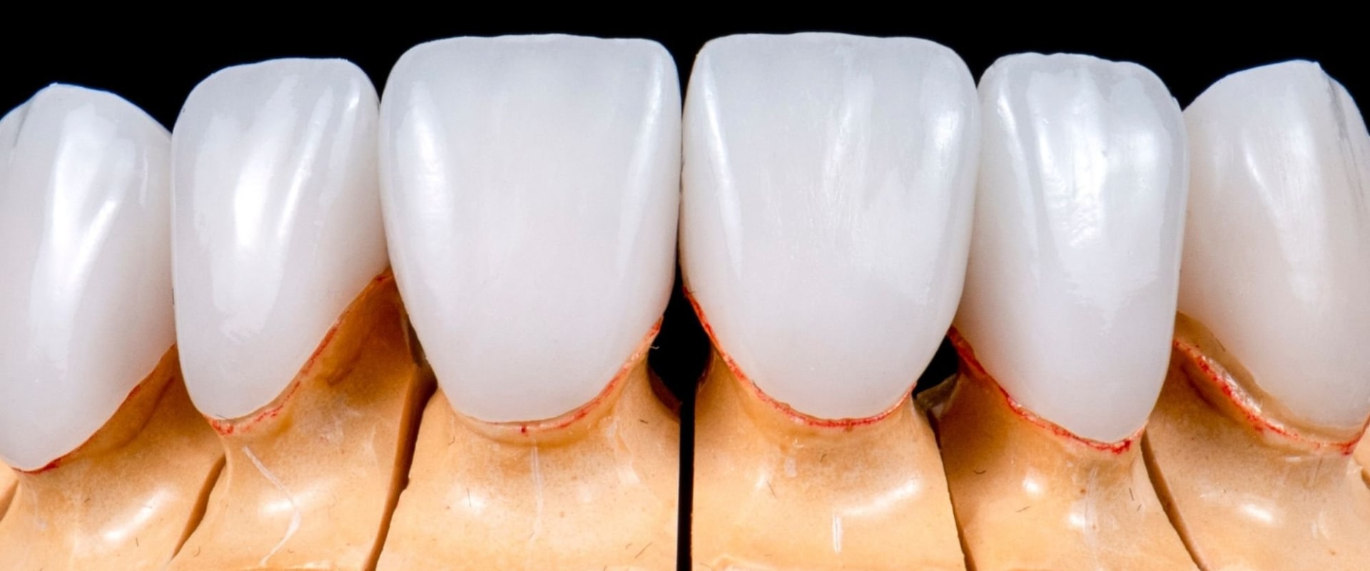 Veneers vs Crowns: Which is the Best Option for Your Teeth?