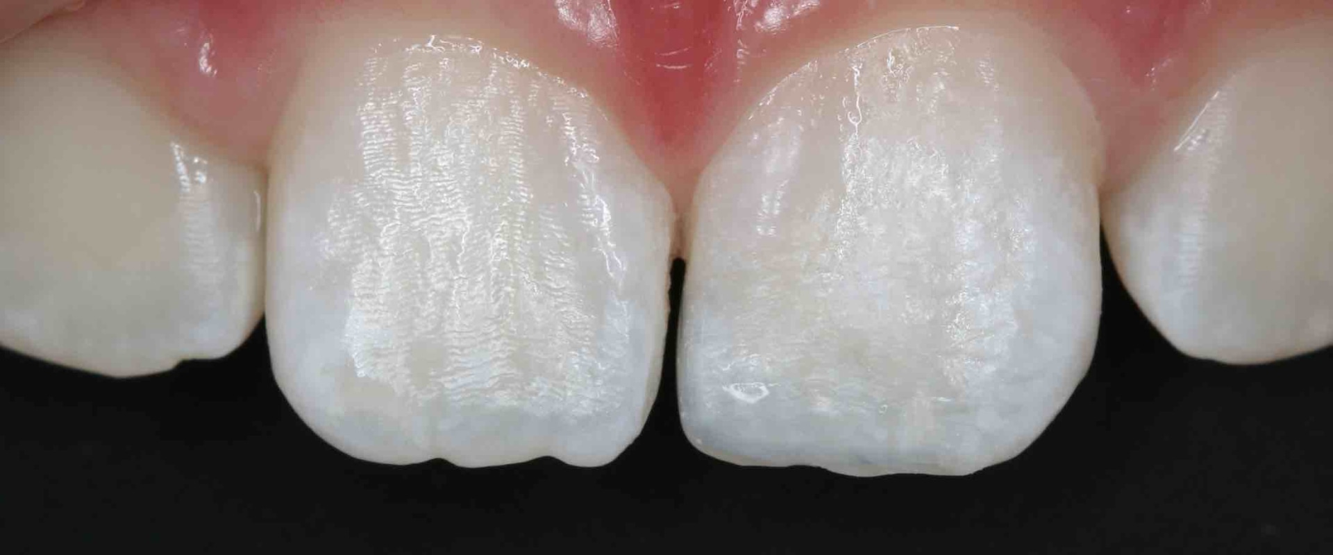 How Long Do Cosmetic Fillings Last on Front Teeth?