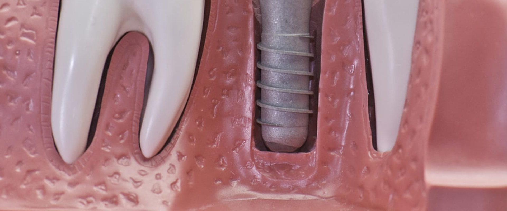 Does medical cover dental implants?
