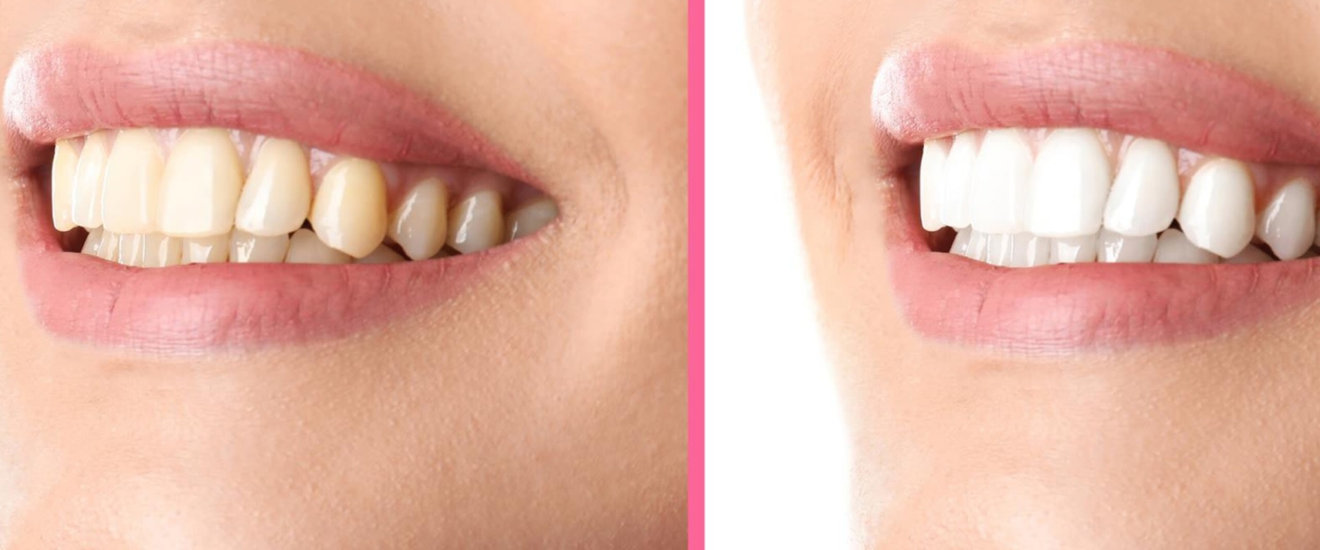 The Best Cosmetic Dental Procedures in Beverly Hills by Song Cosmetic Dentistry
