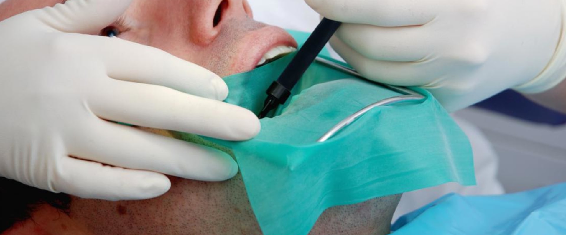 Is a Root Canal Treatment a Surgical Procedure?