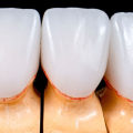 Veneers vs Crowns: Which is the Best Option for Your Teeth?