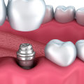 Are Dental Implants a Cosmetic Procedure?
