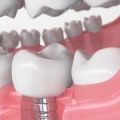 What Type of Dental Work Involves Implants?