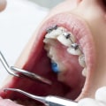 Can You Get Braces from a Normal Dentist?