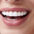 How Much Does it Cost to Shape Your Teeth? A Guide to Cosmetic Dentistry