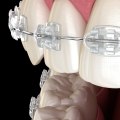 What Do Cosmetic Braces Do? A Comprehensive Guide