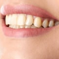 The Best Cosmetic Dental Procedures in Beverly Hills by Song Cosmetic Dentistry