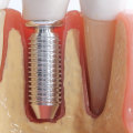 Are You a Good Candidate for Dental Implants?