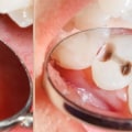 Cosmetic Fillings: A Tooth-Colored Alternative to Traditional Amalgam Fillings