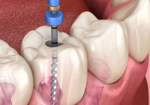 Can Most Dentists Perform Root Canals?