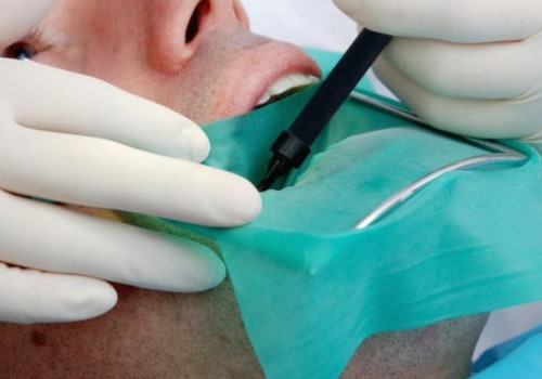 Can a Regular Dentist Perform a Root Canal?