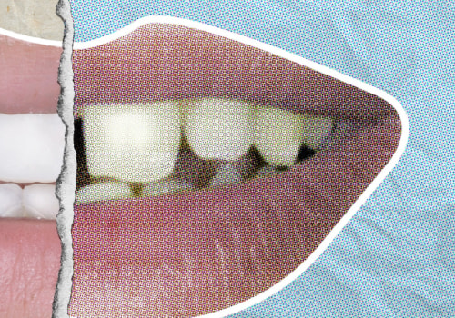 How Much Does it Cost to Get Your Teeth Fixed Like Celebrities?