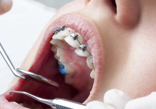 Can You Get Braces from a Normal Dentist?
