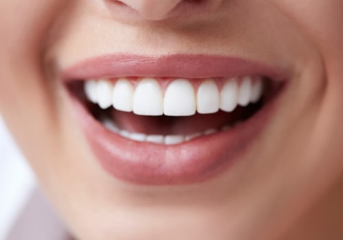 How Much Does it Cost to Shape Your Teeth? A Guide to Cosmetic Dentistry