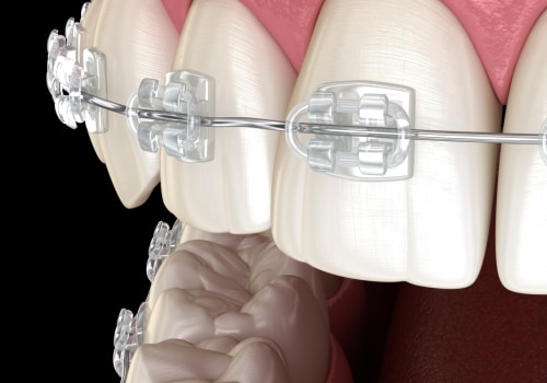 What Do Cosmetic Braces Do? A Comprehensive Guide