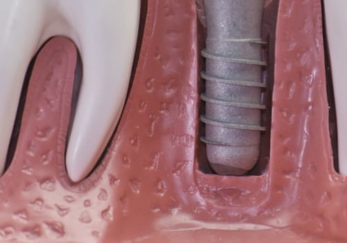 Does Medical Insurance Cover Dental Implants?