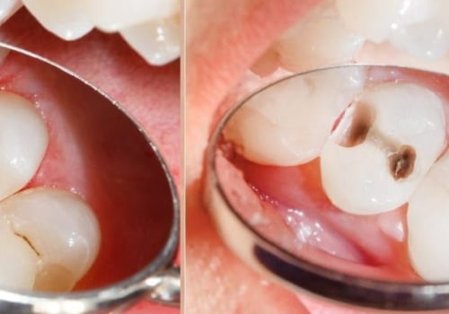 Cosmetic Fillings: A Tooth-Colored Alternative to Traditional Amalgam Fillings